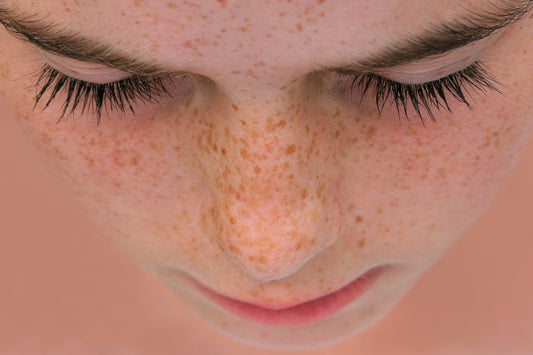 How to Tell if Your Freckles Are Safe This Summer